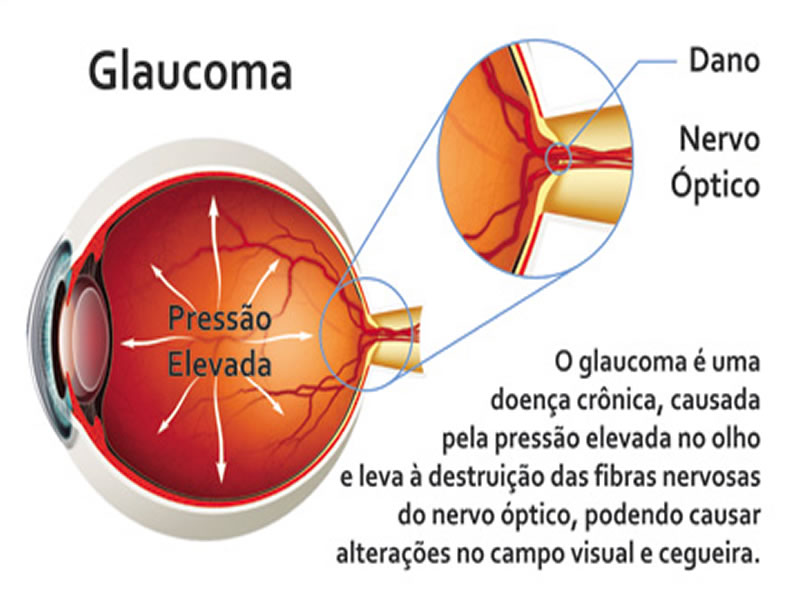 Exame gratuito de Glaucoma em Tubarão
